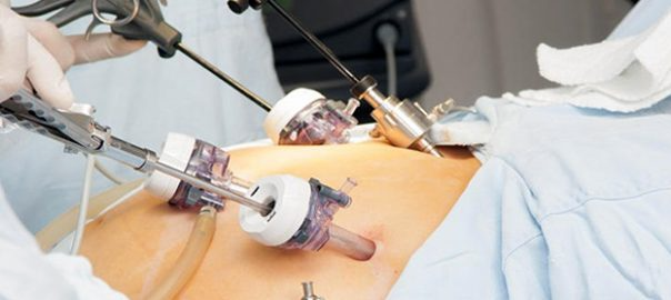 Laparoscopy-for-Diagnosis-and-Treatment-of-Endometriosis